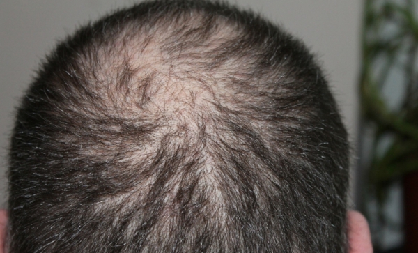 Problem z łysieniem? - Na ratunek przychodzi mikropigmentacja skóry głowy.