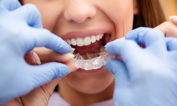 Na czym polega metoda leczenia ortodontycznego Invisalign?